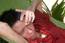 Bộ Y tế: Bệnh “lạ” không phải bệnh ghẻ cóc