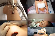 Đau đớn tột cùng khi phẫu thuật thẩm mỹ