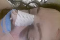 Mù mắt vì nâng mũi 