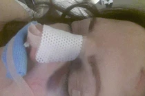 Mù mắt vì nâng mũi 