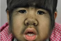 Đáng thương bé gái TQ trở thành “người sói”