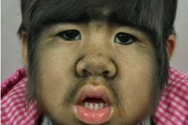 Đáng thương bé gái TQ trở thành “người sói”