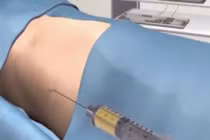 Cấy mỡ tự thân hiệu quả đến đâu?