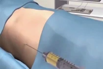 Cấy mỡ tự thân hiệu quả đến đâu?