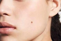 Nốt ruồi nào dễ phá hỏng hôn nhân, sự nghiệp?