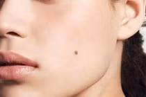 Nốt ruồi nào dễ phá hỏng hôn nhân, sự nghiệp?