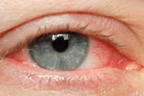 Dịch đau mắt đỏ bùng phát ở Quảng Ngãi