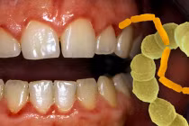 Hình ảnh khủng khiếp về răng nướu