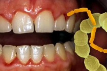 Hình ảnh khủng khiếp về răng nướu