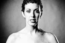 Sốc với những vết thẹo sau phẫu thuật ung thư vú