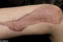 Bị vi khuẩn ăn cụt tay, chân khi đi dã ngoại