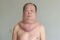 Người đàn ông bị u cổ rộng bằng vai