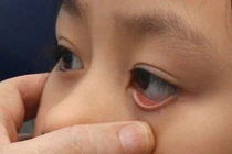 Cần điều trị sớm khi bị lác mắt