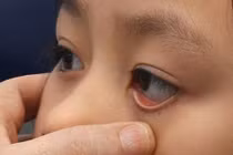 Cần điều trị sớm khi bị lác mắt