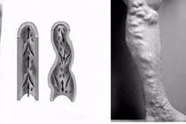 Tĩnh mạch dãn bằng con lươn chữa như thế nào?