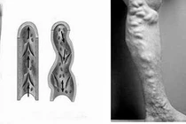 Tĩnh mạch dãn bằng con lươn chữa như thế nào?