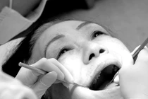 Mổ u tuyến nước bọt gây liệt mặt?