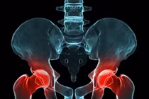 Viêm cột sống dính khớp dễ bị liệt tứ chi, lao phổi