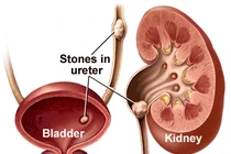 “Siêu thuốc” đông y đánh tan sỏi thận
