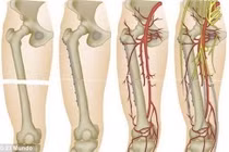 Ca ghép xương có khối u “khủng” hy hữu