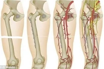 Ca ghép xương có khối u “khủng” hy hữu