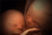 Cặp sinh đôi, sinh ba “hôn nhau” trong bụng mẹ