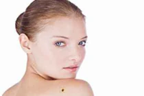 Khám phá nốt ruồi may mắn sau lưng 