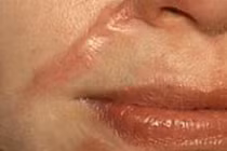 Thực hư vụ nữ sinh huyện Cần Giờ “bị rạch mặt“