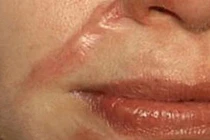 Thực hư vụ nữ sinh huyện Cần Giờ “bị rạch mặt“