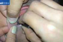 Clip: Rợn người gắp con bướm từ tai người đàn ông