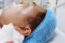 Độn thái dương ở cơ sở thẩm mỹ “chui“, nam thanh niên nhập viện