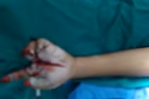 Nổ pháo, bé trai nhập viện với bàn tay chỉ còn 1 ngón