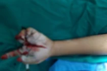 Nổ pháo, bé trai nhập viện với bàn tay chỉ còn 1 ngón