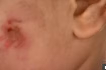 Bé 17 tháng kín vết cắn trên người, lời giải thích của cô giáo càng "dậy sóng"