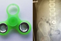 Bé gái suýt tắc thở vì trò chơi spinner đang khuấy đảo trẻ em