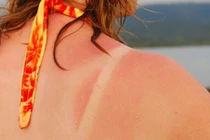 Điều gì xảy ra với cơ thể khi làn da bị cháy nắng