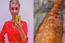 Xót xa cô gái tiền mất tật mang vì tẩy lông chân 