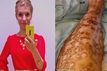 Xót xa cô gái tiền mất tật mang vì tẩy lông chân 