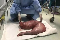 Suýt mất mạng vì táo bón kinh niên, ruột già chứa 13kg chất thải