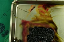 Hoảng hồn người đàn ông có 800 hạt "trân châu" trong túi mật