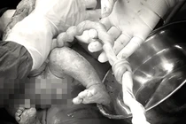 Cứu sống thai nhi có nút thắt dây rốn hiếm gặp 