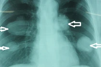 Kinh hoàng hàng nghìn sán chó làm tổ trong phổi người