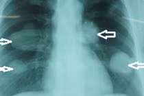 Kinh hoàng hàng nghìn sán chó làm tổ trong phổi người