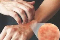 Ngứa da do ký sinh trùng