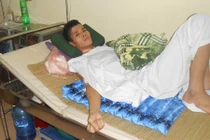 Cứu sống bệnh nhân vỡ thực quản do nổ khí gas