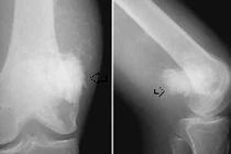 Ba loại ung thư xương dễ di căn và tử vong 