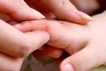 Nguyên tắc điều trị tay chân miệng