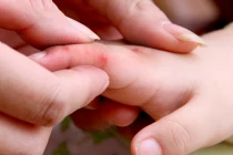 Nguyên tắc điều trị tay chân miệng