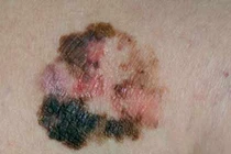 Bướu ác “hắc tố” ở da