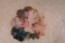 Bướu ác “hắc tố” ở da